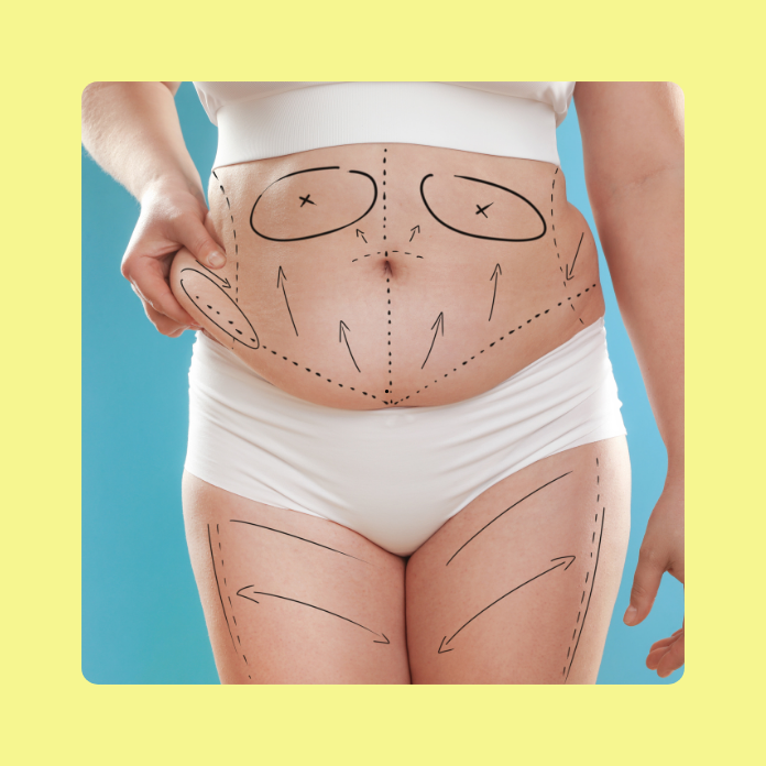 Tummy Tuck Procedure in Maryland