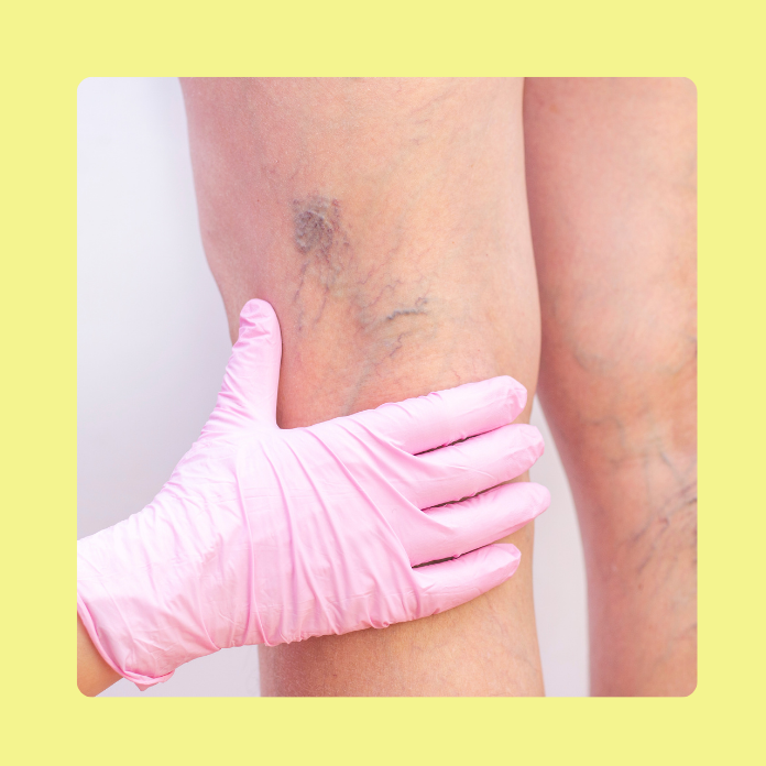 varicose veins treatments in Maryland 
